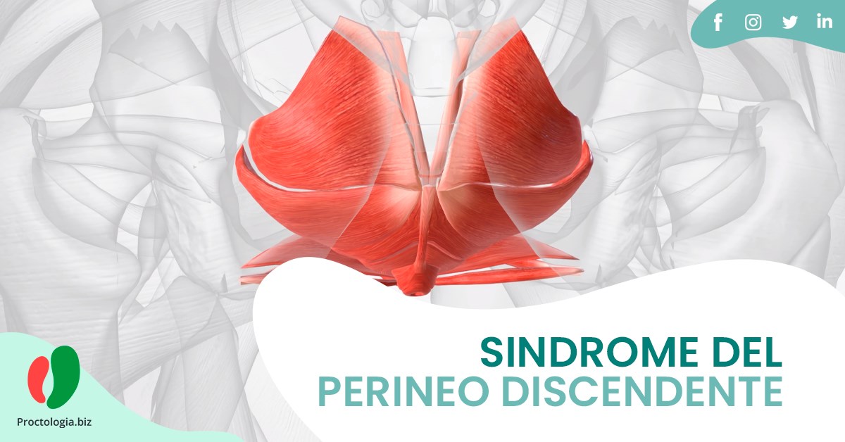 Sindrome del Perineo Discendente: Cosa è e Come Si Cura?
